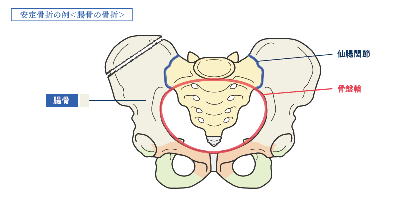 骨盤_安定骨折・腸骨