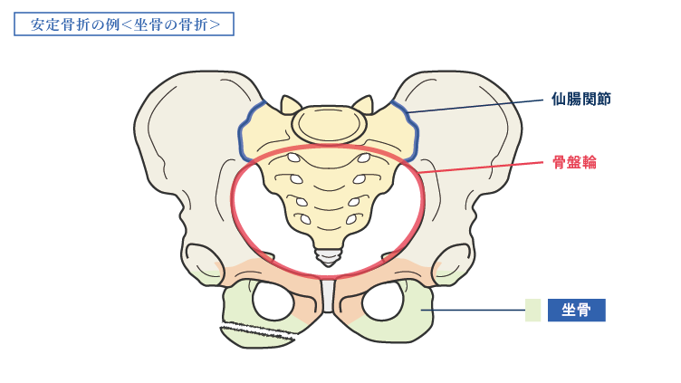 骨盤_安定骨折・坐骨