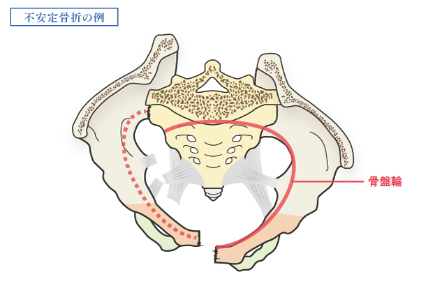 骨盤_不安定骨折