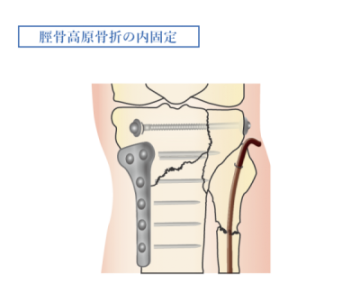膝関節_脛骨高原骨折の内固定