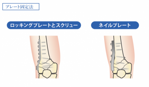 膝関節_プレート固定法