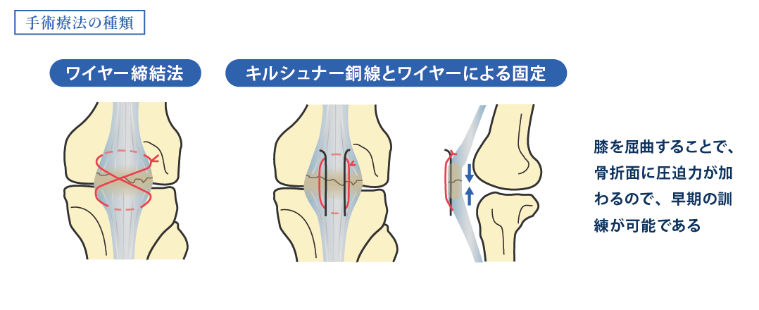 膝関節_手術療法の種類