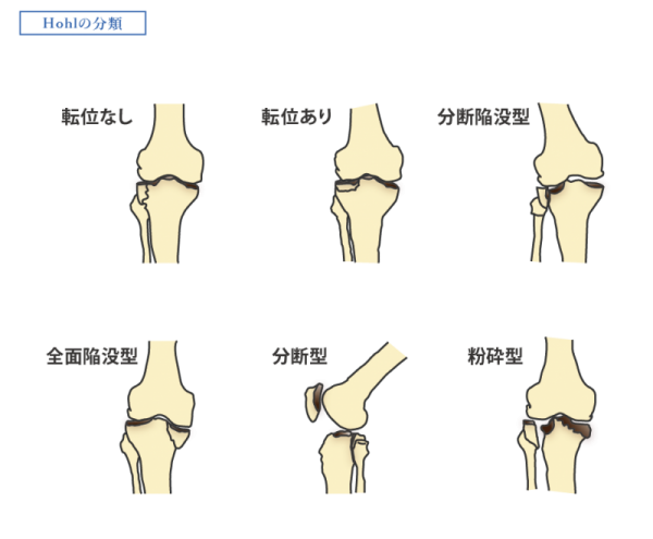 膝関節_Hohlの分類