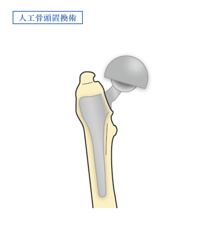 人工骨頭置換術