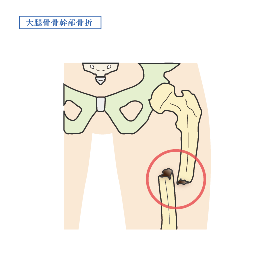 大腿骨骨幹部骨折